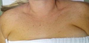 BBL前光面部女性患者胸部6482例
