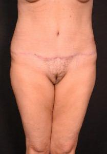 after tummy tuck front view female patient case 6727