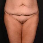 腹部除皱前正面视图女性患者病例6727