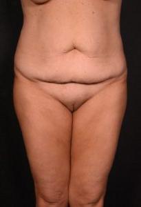 before tummy tuck front view female patient case 6727