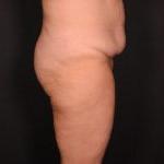 腹部除皱前侧视图女性患者病例6727