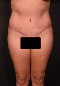 after tummy tuck front view female patient case 6977