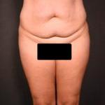腹部除皱前正面视图女性患者病例6977
