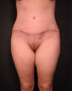 after liposuction with tummy tuck front view case 7099