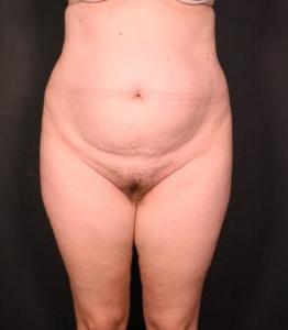 before liposuction with tummy tuck front view case 7099